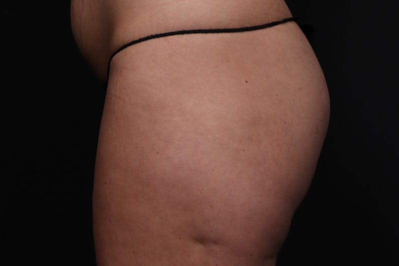 Brazilian Butt Lift Before & After Gallery - Patient 145423 - Image 5