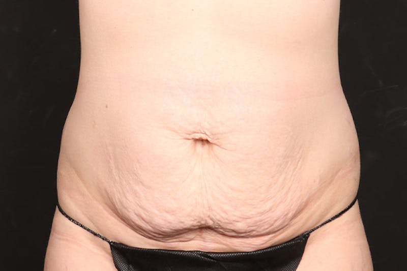 Abdominoplasty Before & After Gallery - Patient 260192 - Image 1