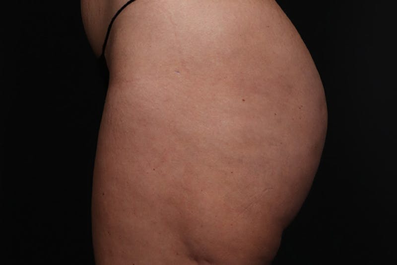 Brazilian Butt Lift Before & After Gallery - Patient 145423 - Image 6