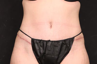 Abdominoplasty Before & After Gallery - Patient 260192 - Image 2