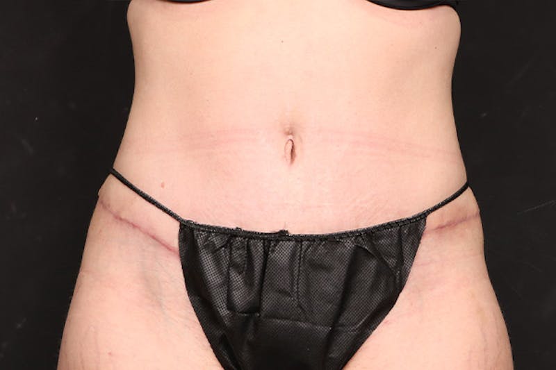 Abdominoplasty Before & After Gallery - Patient 260192 - Image 2