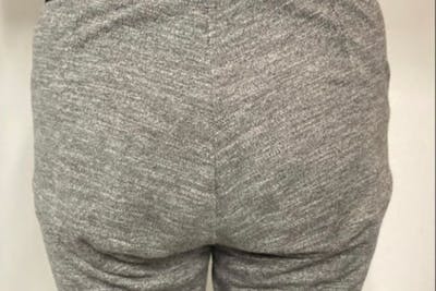 Brazilian Butt Lift Before & After Gallery - Patient 238860 - Image 1