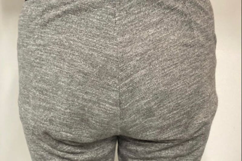 Brazilian Butt Lift Before & After Gallery - Patient 238860 - Image 1