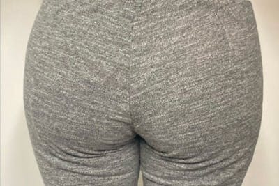 Brazilian Butt Lift Before & After Gallery - Patient 238860 - Image 2