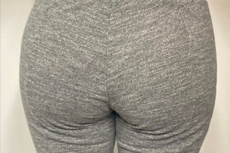 Brazilian Butt Lift Before & After Gallery - Patient 238860 - Image 2