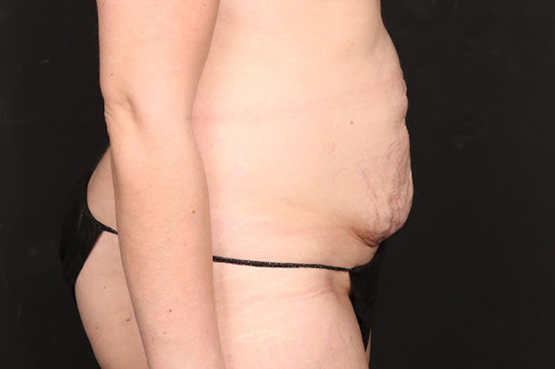 Abdominoplasty Before & After Gallery - Patient 260192 - Image 5