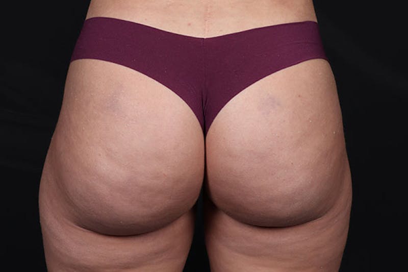Brazilian Butt Lift Before & After Gallery - Patient 400044 - Image 2