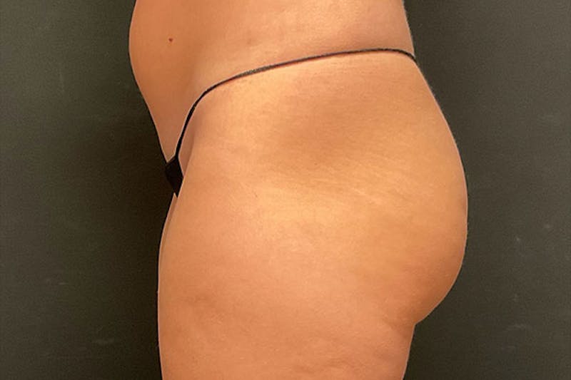 Brazilian Butt Lift Before & After Gallery - Patient 400044 - Image 3