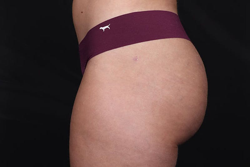 Brazilian Butt Lift Before & After Gallery - Patient 400044 - Image 4