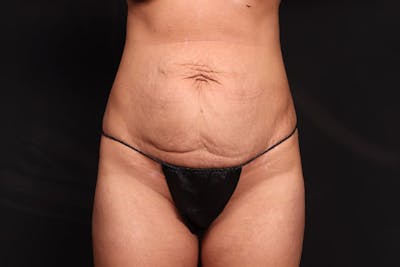 Brazilian Butt Lift Before & After Gallery - Patient 314799 - Image 1