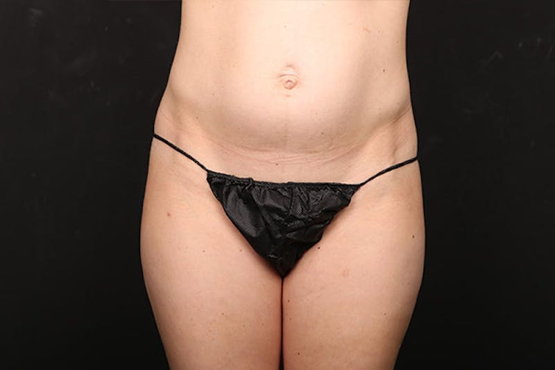Mommy Makeover Before & After Gallery - Patient 378547 - Image 7
