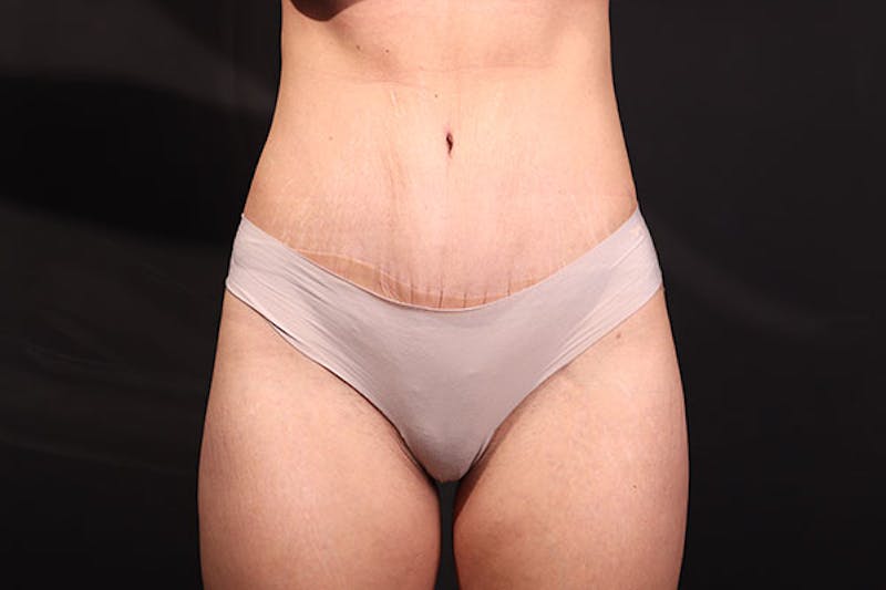 Brazilian Butt Lift Before & After Gallery - Patient 314799 - Image 2