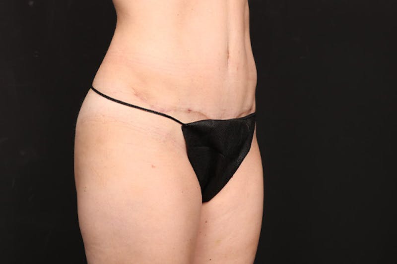 Mommy Makeover Before & After Gallery - Patient 378547 - Image 10