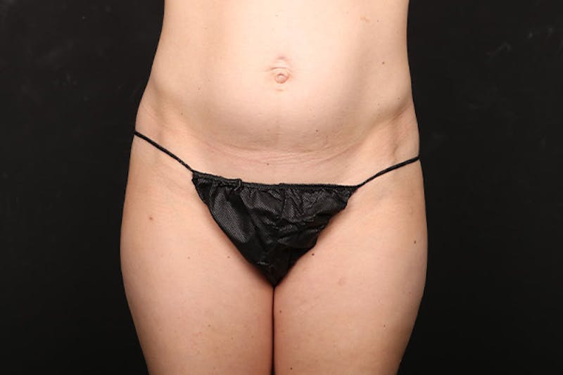 Abdominoplasty Before & After Gallery - Patient 386836 - Image 1