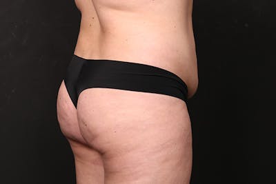 Brazilian Butt Lift Before & After Gallery - Patient 280046 - Image 1