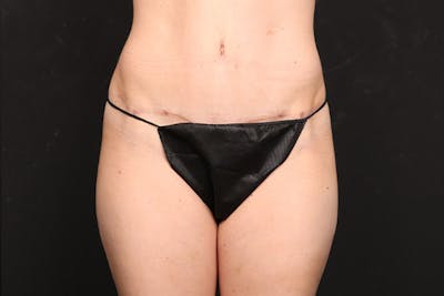 Abdominoplasty Before & After Gallery - Patient 386836 - Image 2