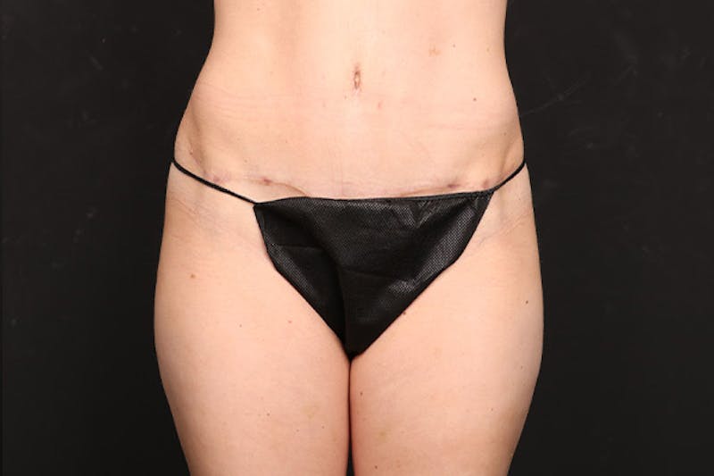 Abdominoplasty Before & After Gallery - Patient 386836 - Image 2