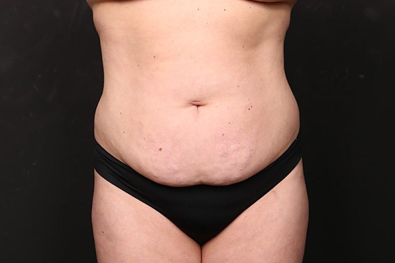 Brazilian Butt Lift Before & After Gallery - Patient 280046 - Image 3