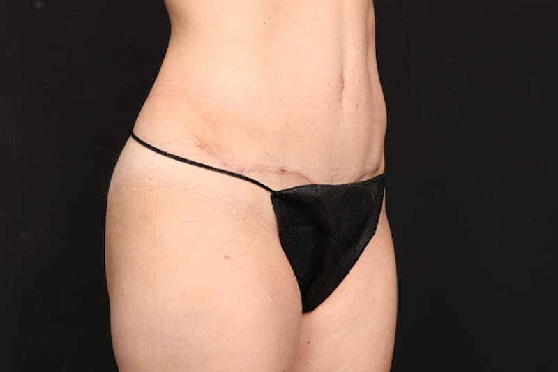 Abdominoplasty Before & After Gallery - Patient 386836 - Image 4
