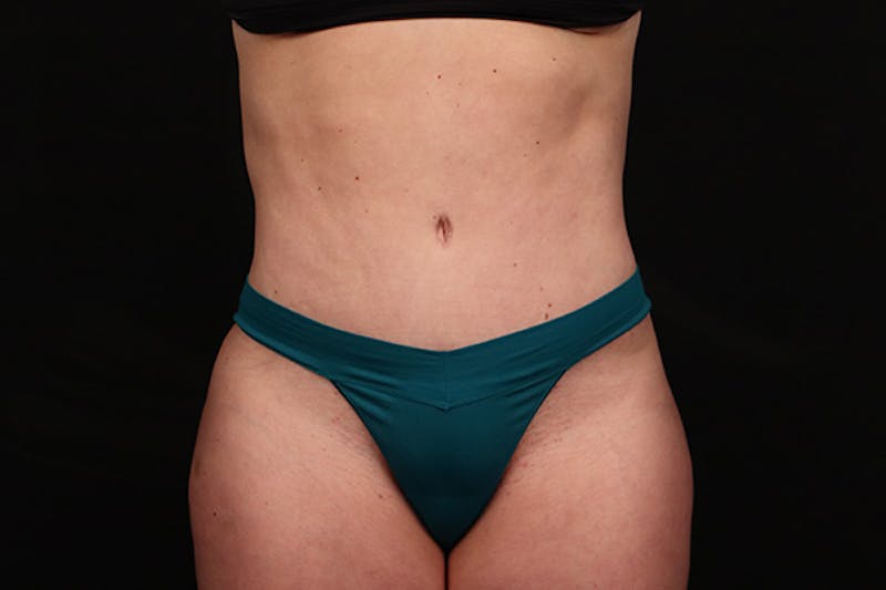 Brazilian Butt Lift Before & After Gallery - Patient 280046 - Image 4
