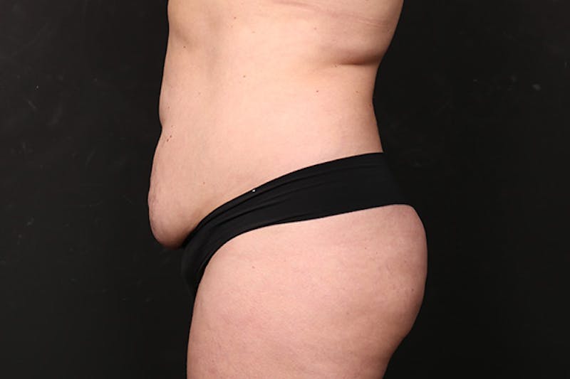 Brazilian Butt Lift Before & After Gallery - Patient 280046 - Image 5