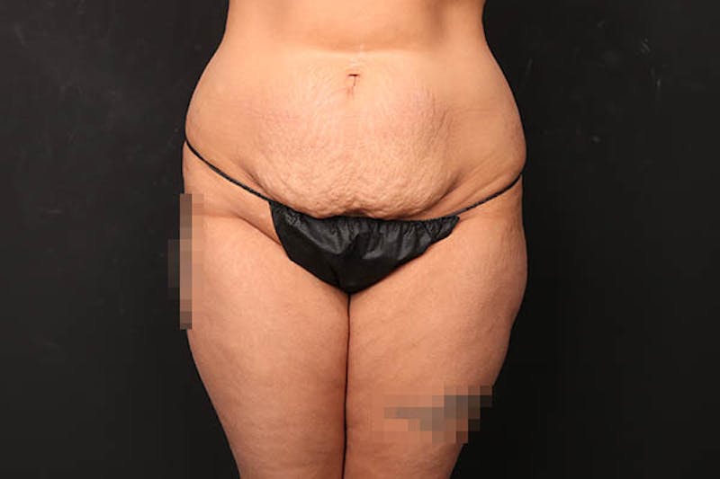 Abdominoplasty Before & After Gallery - Patient 589904 - Image 1