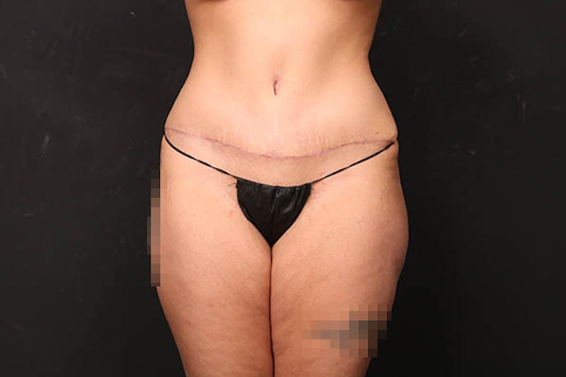Abdominoplasty Before & After Gallery - Patient 589904 - Image 2