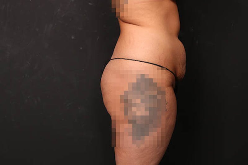 Abdominoplasty Before & After Gallery - Patient 589904 - Image 3