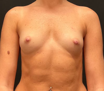 Breast Augmentation Before & After Gallery - Patient 149167 - Image 1
