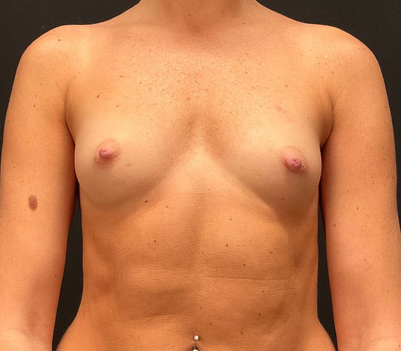 Breast Augmentation Before & After Gallery - Patient 149167 - Image 1