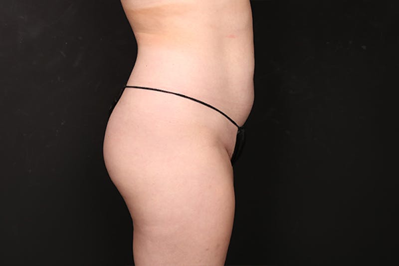 Brazilian Butt Lift Before & After Gallery - Patient 357899 - Image 3