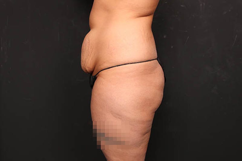 Abdominoplasty Before & After Gallery - Patient 589904 - Image 5