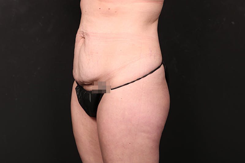 Abdominoplasty Before & After Gallery - Patient 599498 - Image 3