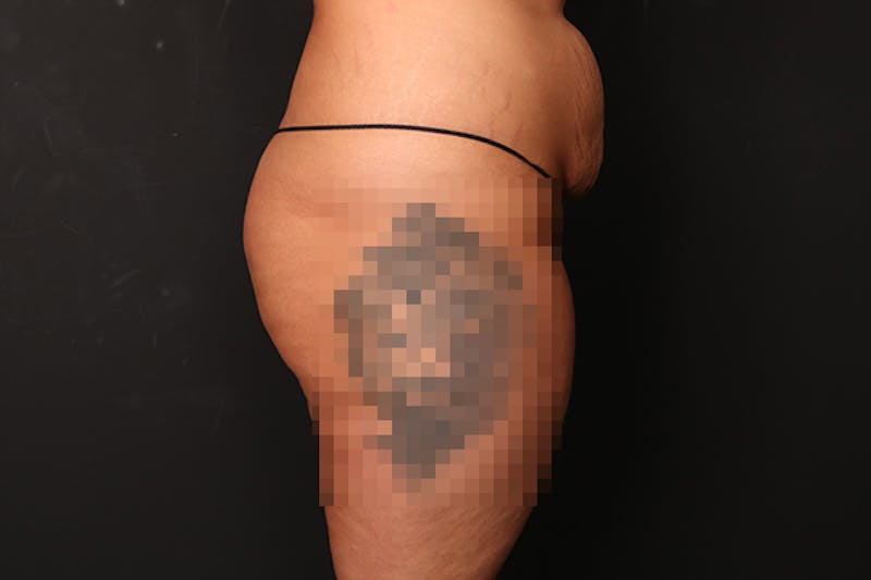 Brazilian Butt Lift Before & After Gallery - Patient 354695 - Image 3