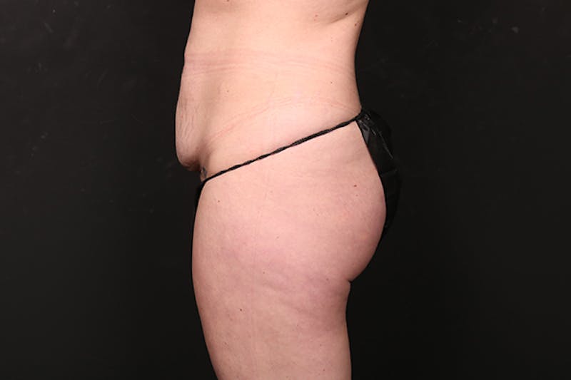 Abdominoplasty Before & After Gallery - Patient 599498 - Image 5