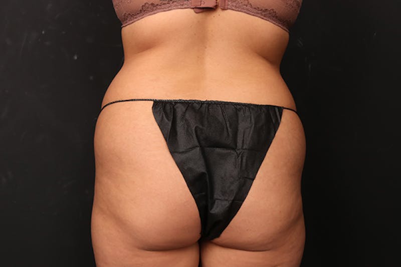 Brazilian Butt Lift Before & After Gallery - Patient 326755 - Image 1