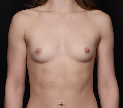 Breast Augmentation Before & After Gallery - Patient 276881 - Image 1