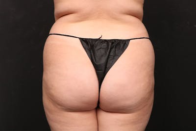 Brazilian Butt Lift Before & After Gallery - Patient 153528 - Image 1
