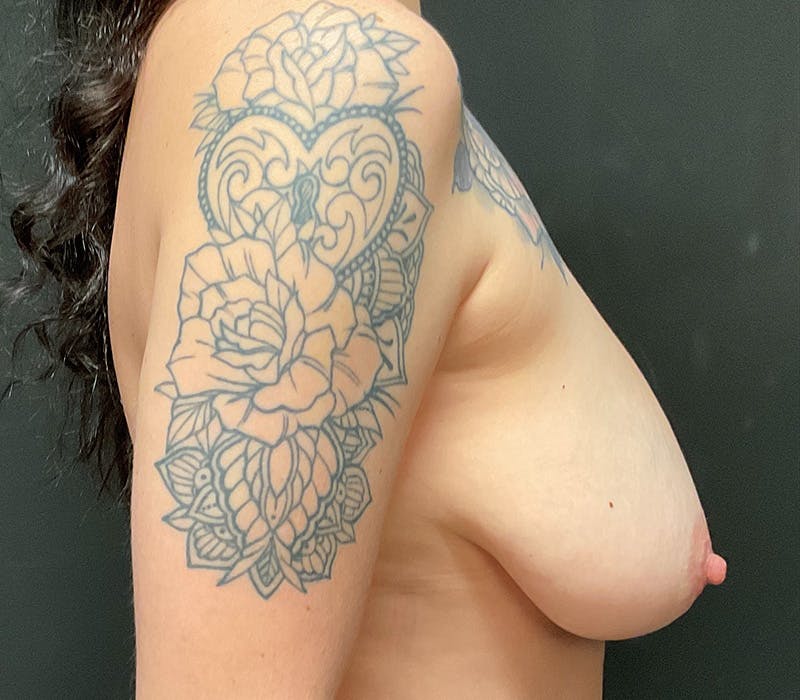 Breast Augmentation with Lift Before & After Gallery - Patient 664015 - Image 5