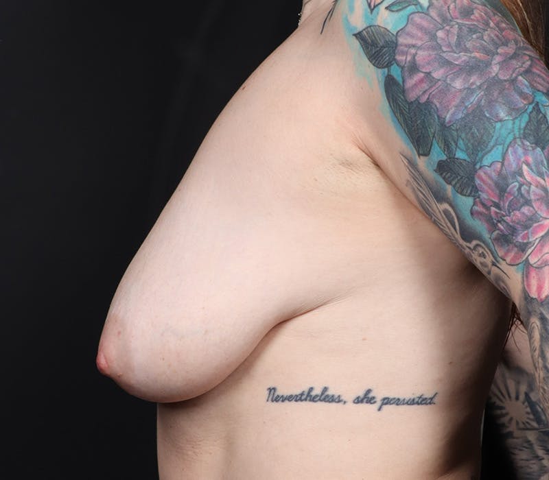 Breast Lift Before & After Gallery - Patient 120367 - Image 5