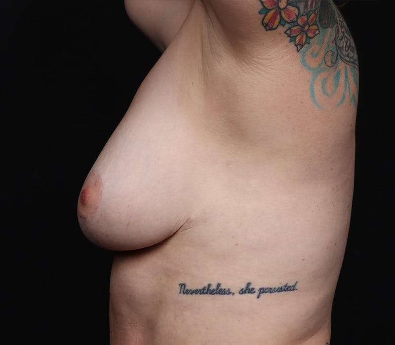 Breast Lift Before & After Gallery - Patient 120367 - Image 6