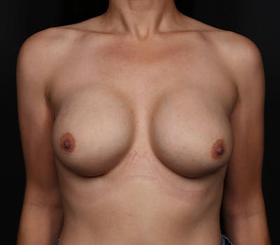 Breast Augmentation Revision Before & After Gallery - Patient 179295 - Image 1