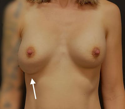 Breast Augmentation Revision Before & After Gallery - Patient 249987 - Image 1