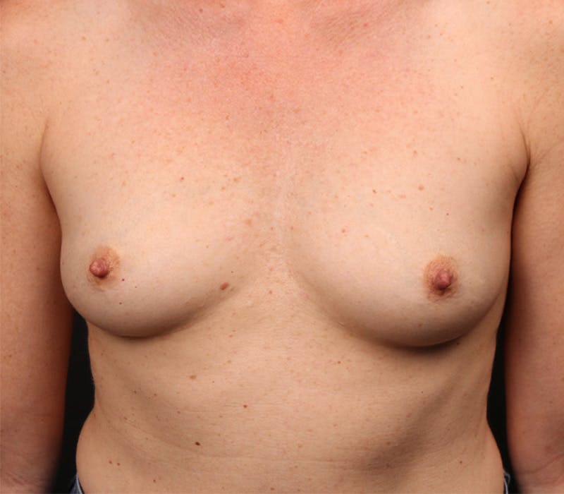 Breast Augmentation Before & After Gallery - Patient 255599 - Image 1