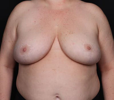 Breast Reduction with Lift Before & After Gallery - Patient 126386 - Image 2