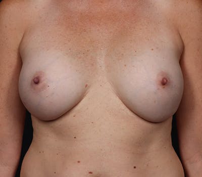Breast Augmentation Before & After Gallery - Patient 255599 - Image 2