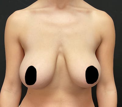 Breast Reduction with Lift Before & After Gallery - Patient 573639 - Image 1