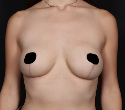 Breast Reduction with Lift Before & After Gallery - Patient 573639 - Image 2