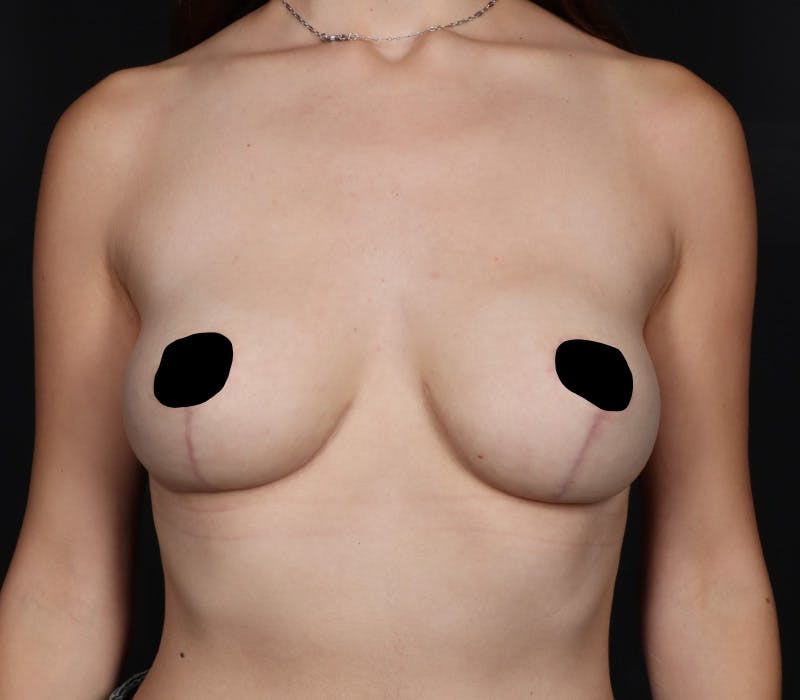 Breast Reduction with Lift Before & After Gallery - Patient 573639 - Image 2