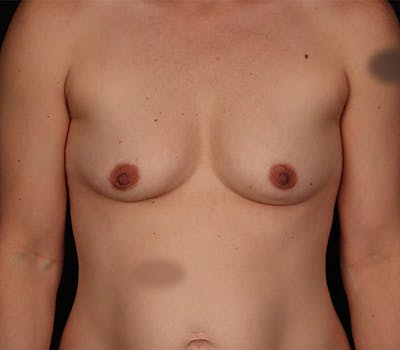 Breast Augmentation Before & After Gallery - Patient 403564 - Image 1